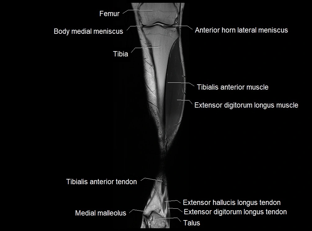 MRI 3T leg (tibia & fibula) labelled coronal cross sectional anatomy image 10.webp